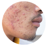 Close up of a man's face. it has red dots and blotches indicating a severe case of acne