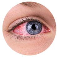 close up of an eye that is red and enflamed