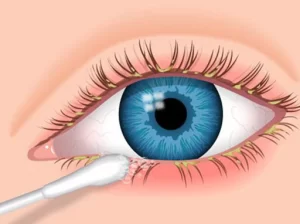drawing of an eye with gunk on it being cleaned with a q-tip