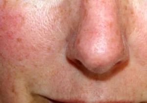 closeup of a person's nose with red blotches indicitive of rosacea