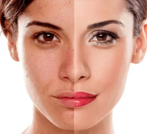 a woman's face divided in hald - one side is blotchy but makeup free, the other side is smooth and wears makeup