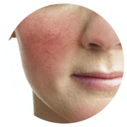 Close up of a young face with unusually rosy cheeks indicative of Rosacea